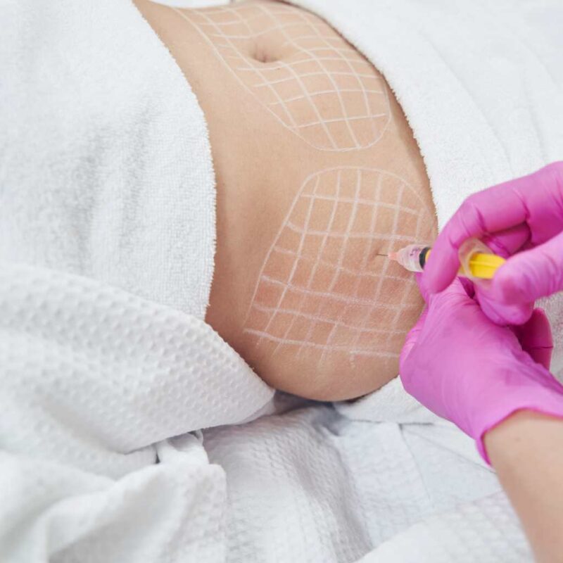 Fat Dissolving Injections at The Face skin clinic, Billericay, Essex