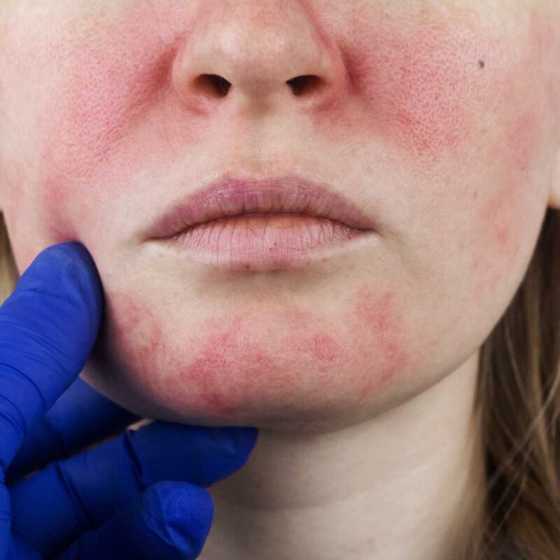 Fotona Rosacea Treatment at The Face skin clinic, Billericay, Essex