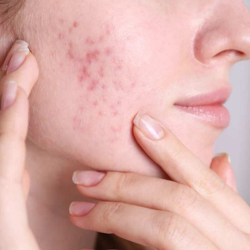Rejuvlift Acne at The Face skin clinic, Billericay, Essex