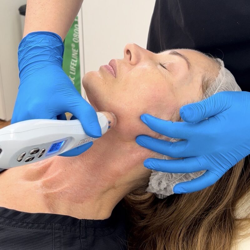 Microneedling is it worth it?